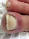 shat's toe